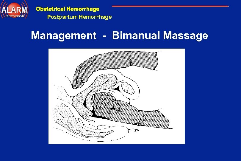 Obstetrical Hemorrhage International Postpartum Hemorrhage Management - Bimanual Massage 