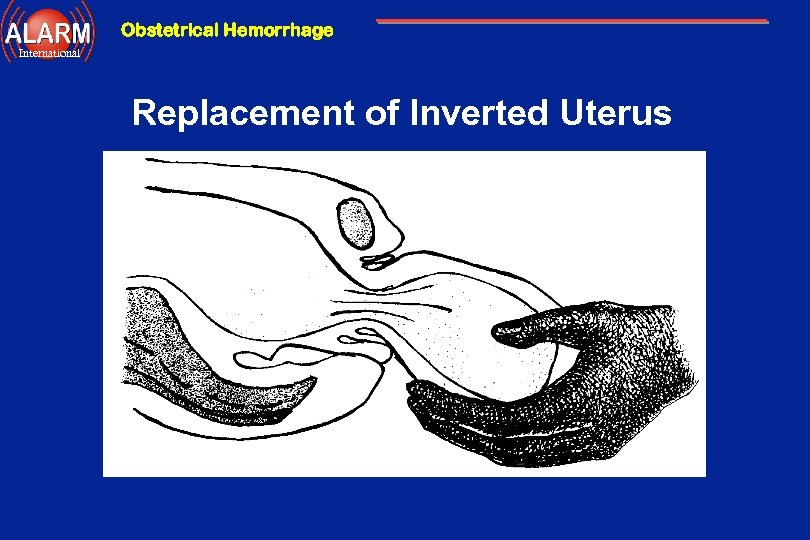 Obstetrical Hemorrhage International Replacement of Inverted Uterus 