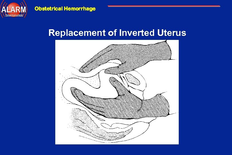 Obstetrical Hemorrhage International Replacement of Inverted Uterus 