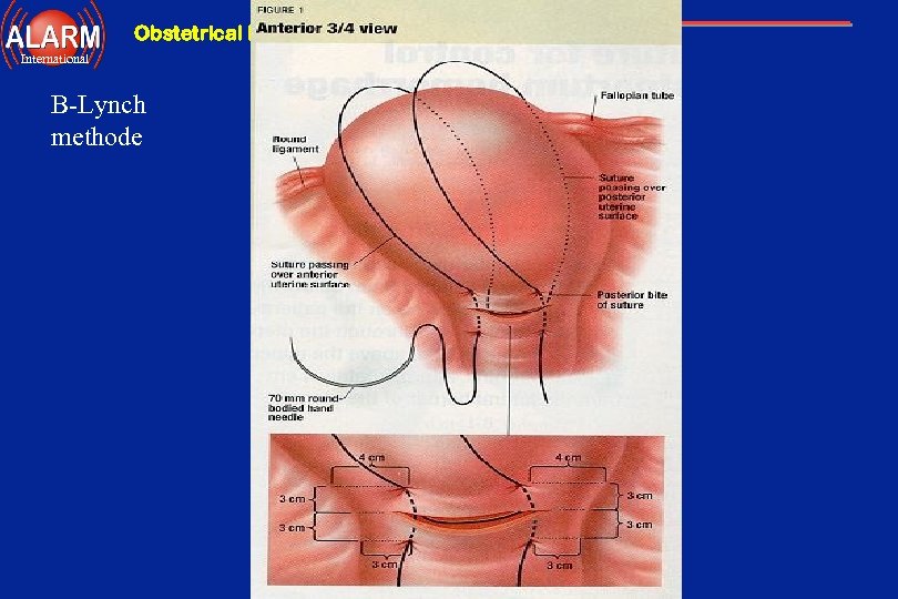 Obstetrical Hemorrhage International B-Lynch methode 