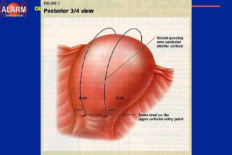 Obstetrical Hemorrhage International 