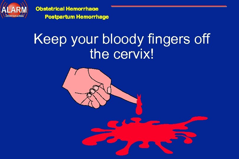 Obstetrical Hemorrhage International Postpartum Hemorrhage Keep your bloody fingers off the cervix! 