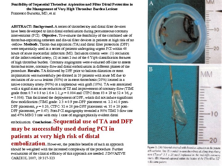 Feasibility of Sequential Thrombus Aspiration and Filter Distal Protection in the Management of Very