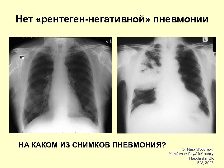 Нет «рентеген-негативной» пневмонии НА КАКОМ ИЗ СНИМКОВ ПНЕВМОНИЯ? Dr Mark Woodhead Manchester Royal Infirmary
