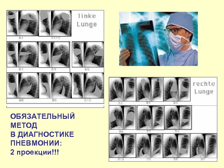 ОБЯЗАТЕЛЬНЫЙ МЕТОД В ДИАГНОСТИКЕ ПНЕВМОНИИ: 2 проекции!!! 