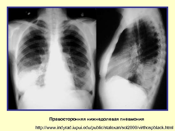 Правосторонняя нижнедолевая пневмония http: //www. indyrad. iupui. edu/public/stalexan/sol 2000/virthospblack. html 