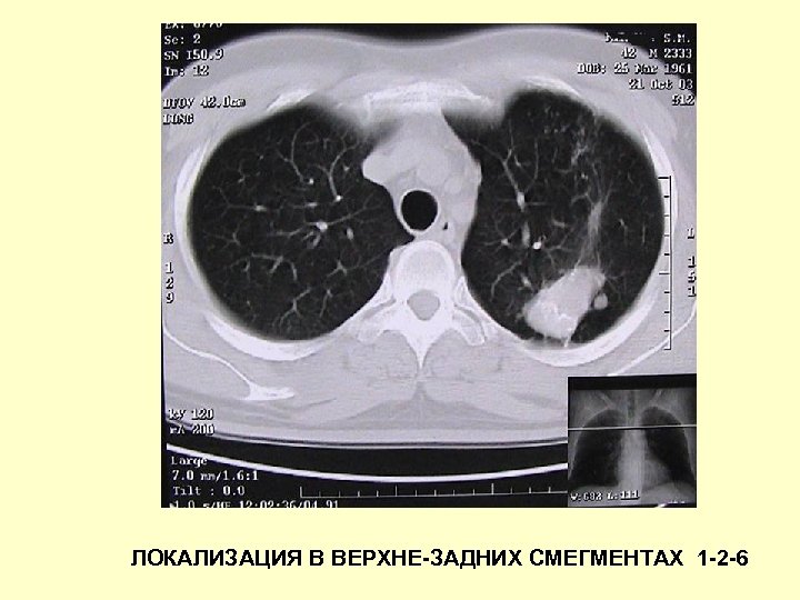 ЛОКАЛИЗАЦИЯ В ВЕРХНЕ-ЗАДНИХ СМЕГМЕНТАХ 1 -2 -6 