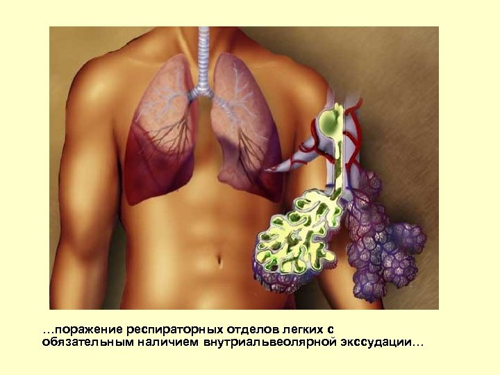 …поражение респираторных отделов легких с обязательным наличием внутриальвеолярной экссудации… 