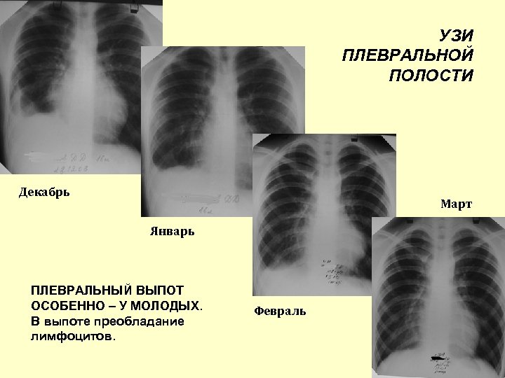 УЗИ ПЛЕВРАЛЬНОЙ ПОЛОСТИ Декабрь Март Январь ПЛЕВРАЛЬНЫЙ ВЫПОТ ОСОБЕННО – У МОЛОДЫХ. В выпоте