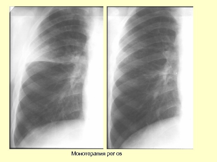 Монотерапия per os 