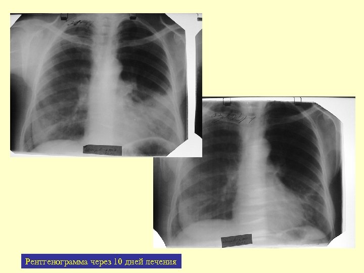 Рентгенограмма через 10 дней лечения 
