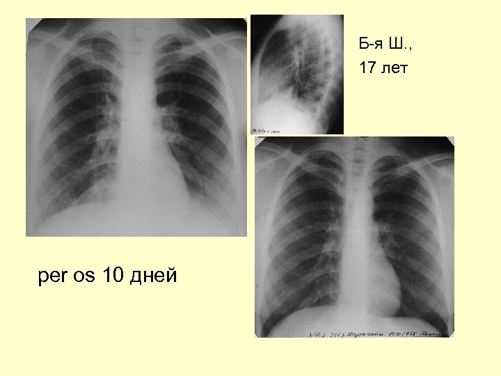 Б-я Ш. , 17 лет per os 10 дней 