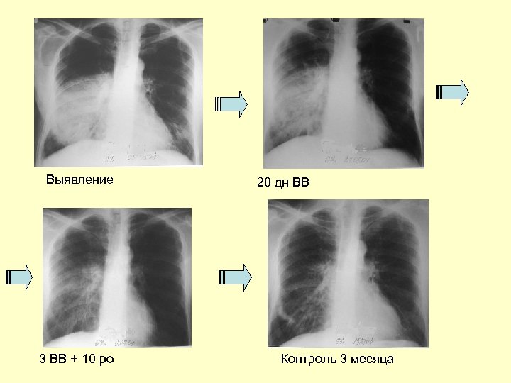 Выявление 3 ВВ + 10 po 20 дн ВВ Контроль 3 месяца 