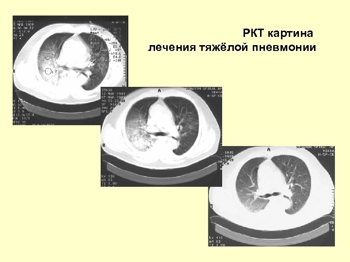 РКТ картина лечения тяжёлой пневмонии 