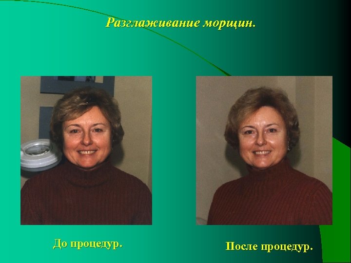Разглаживание морщин. До процедур. После процедур. 