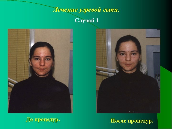 Лечение угревой сыпи. Случай 1 До процедур. После процедур. 
