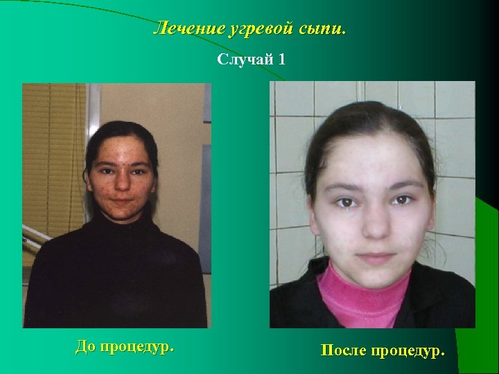 Лечение угревой сыпи. Случай 1 До процедур. После процедур. 
