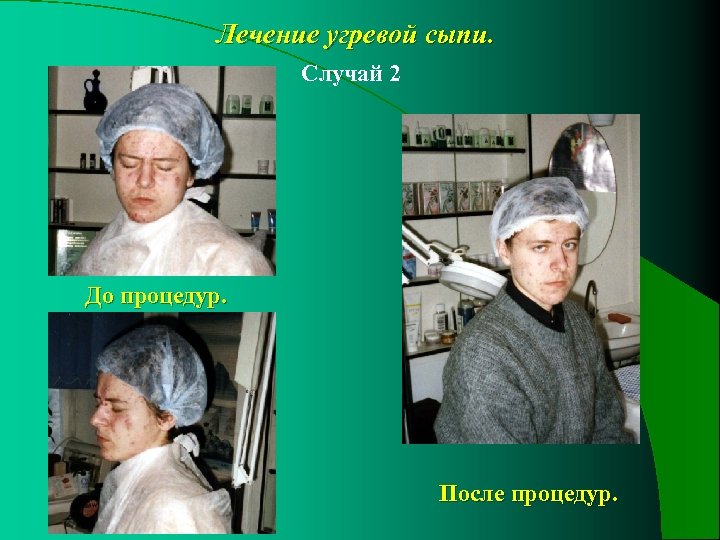 Лечение угревой сыпи. Случай 2 До процедур. После процедур. 