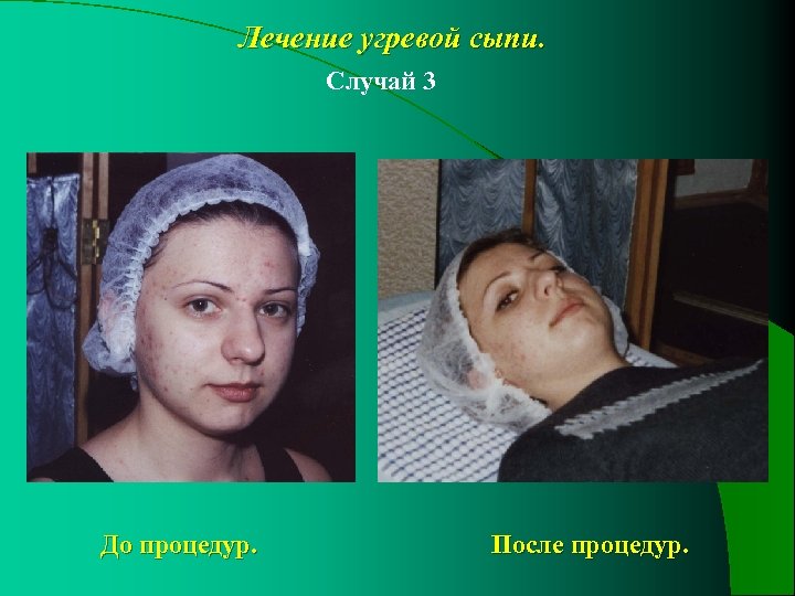 Лечение угревой сыпи. Случай 3 До процедур. После процедур. 