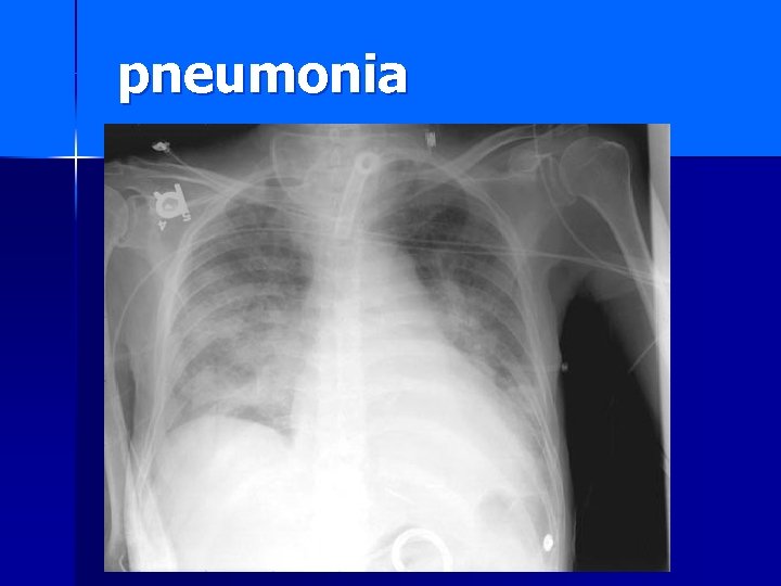 pneumonia 