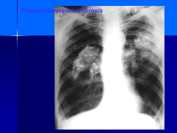 Progressive massive fibrosis 