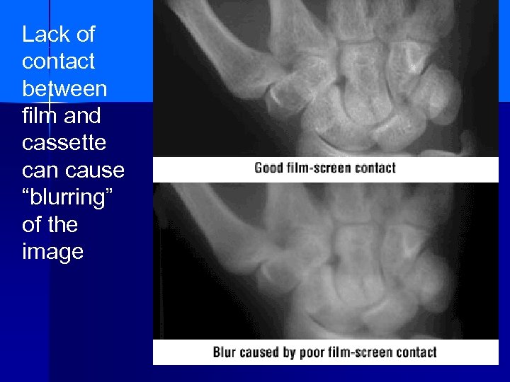 Lack of contact between film and cassette can cause “blurring” of the image 