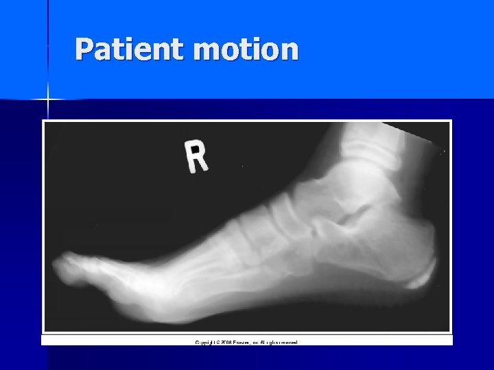 Patient motion 