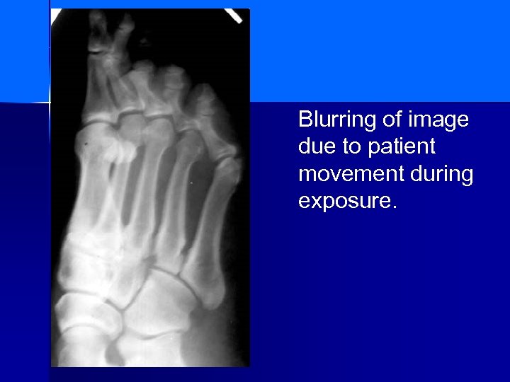 Blurring of image due to patient movement during exposure. 