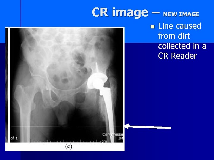 CR image – NEW IMAGE n Line caused from dirt collected in a CR