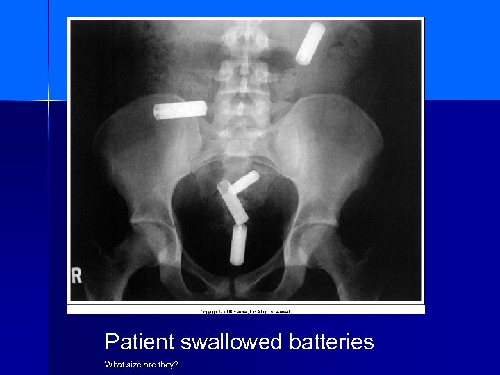 Patient swallowed batteries What size are they? 