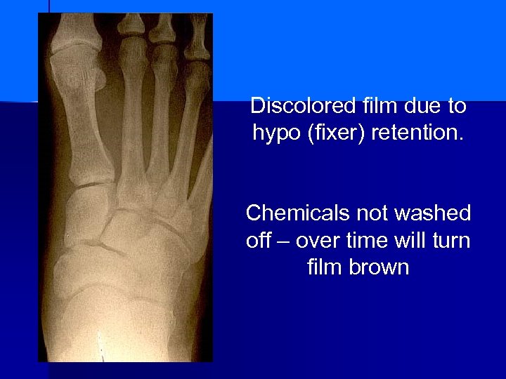 Discolored film due to hypo (fixer) retention. Chemicals not washed off – over time