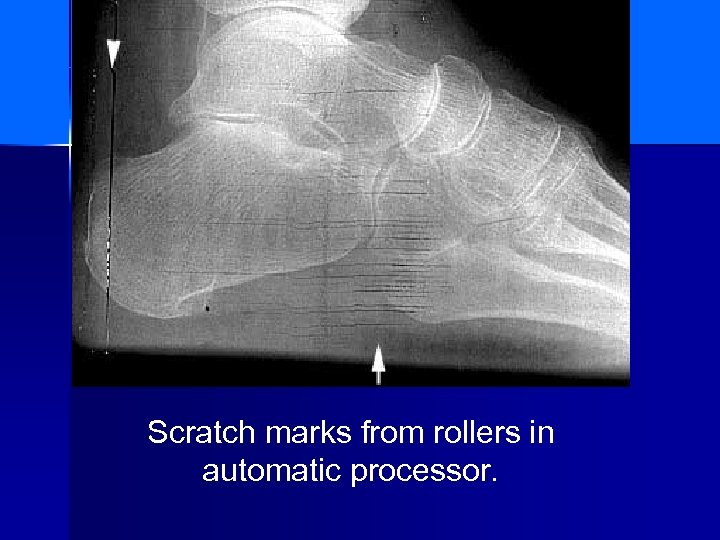 Scratch marks from rollers in automatic processor. 