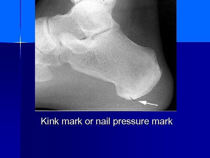 Kink mark or nail pressure mark 