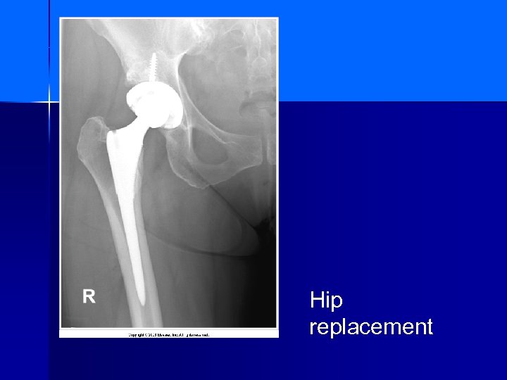 Hip replacement 