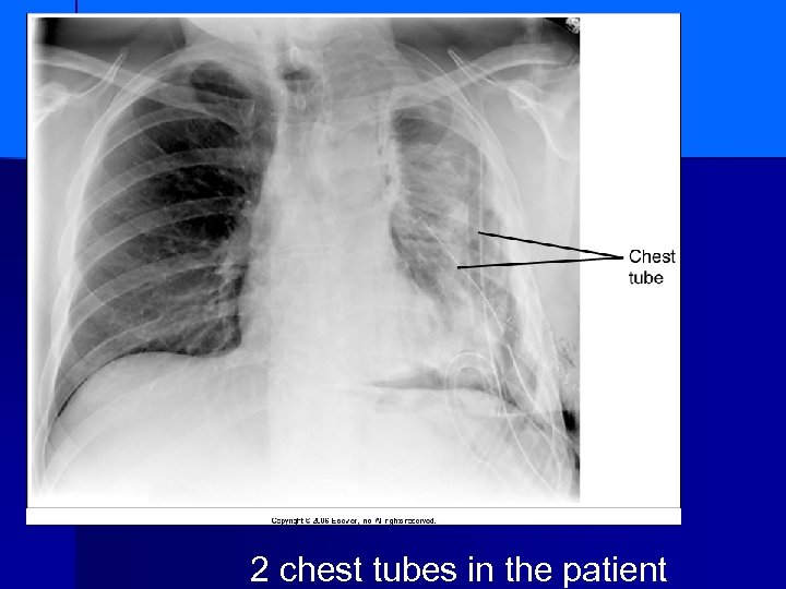 2 chest tubes in the patient 