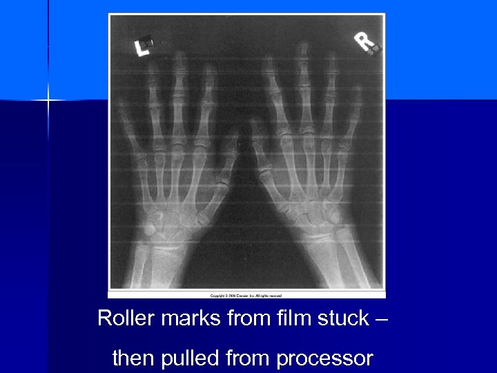 Roller marks from film stuck – then pulled from processor 