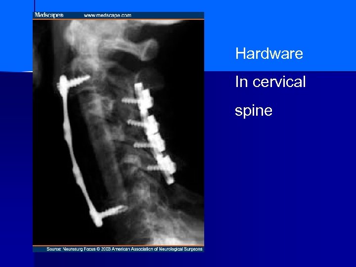 Hardware In cervical spine 