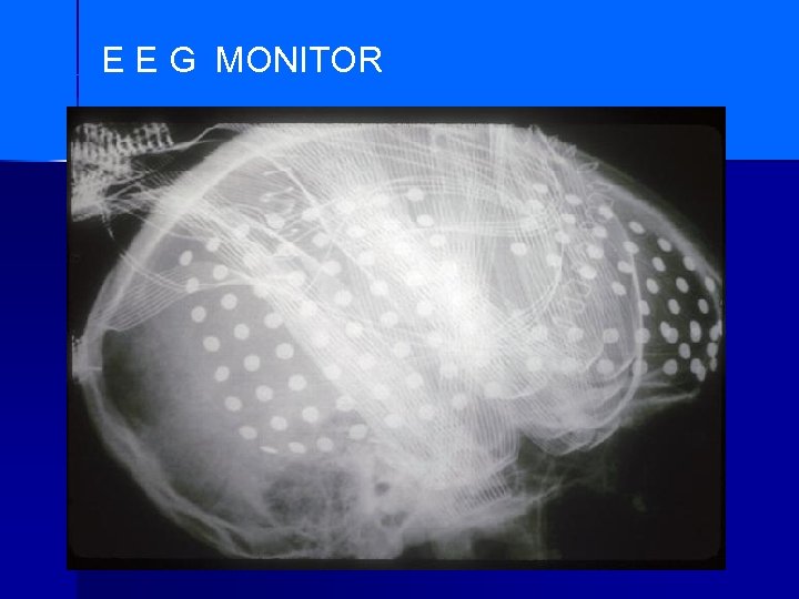 E E G MONITOR 