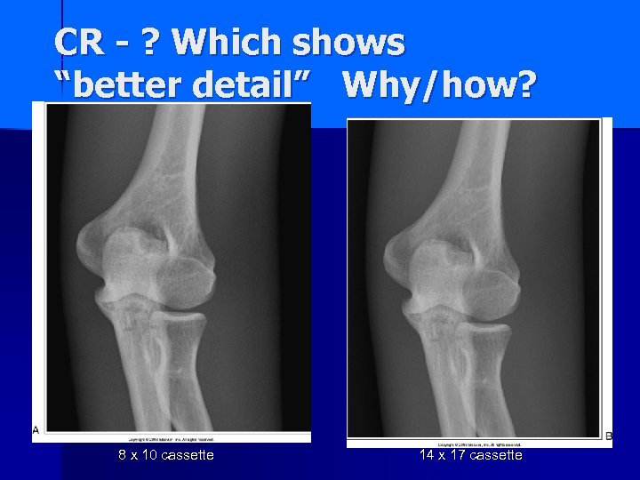 CR - ? Which shows “better detail” Why/how? 8 x 10 cassette 14 x