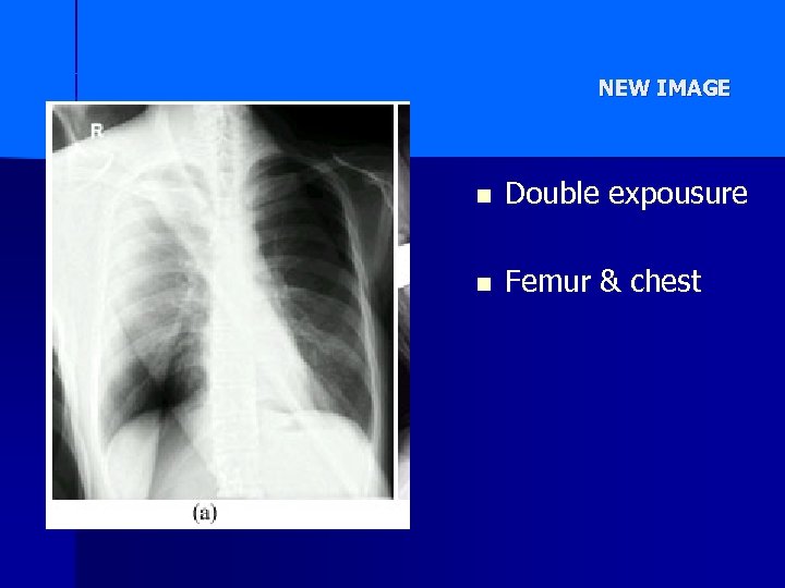 NEW IMAGE n Double expousure n Femur & chest 