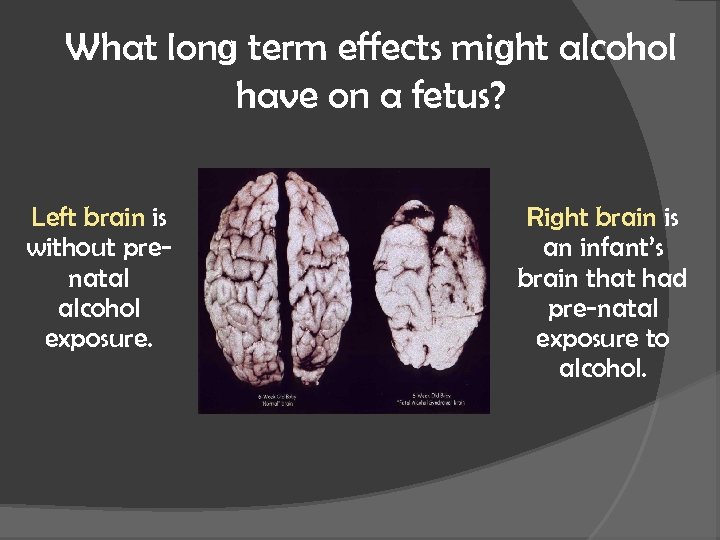 What long term effects might alcohol have on a fetus? Left brain is without