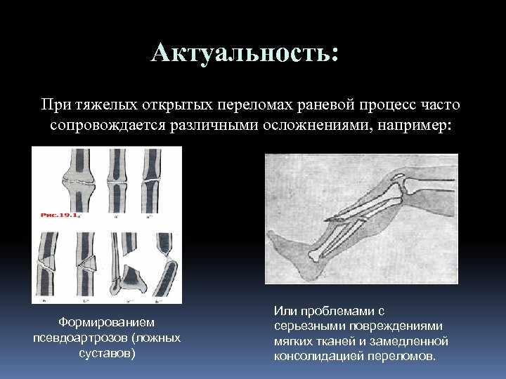 Актуальность: При тяжелых открытых переломах раневой процесс часто сопровождается различными осложнениями, например: Формированием псевдоартрозов