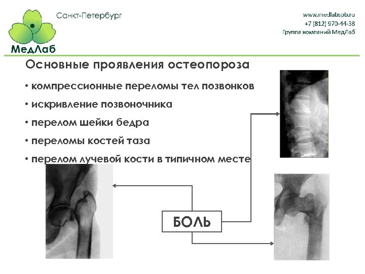 Основные проявления остеопороза • компрессионные переломы тел позвонков • искривление позвоночника • перелом шейки