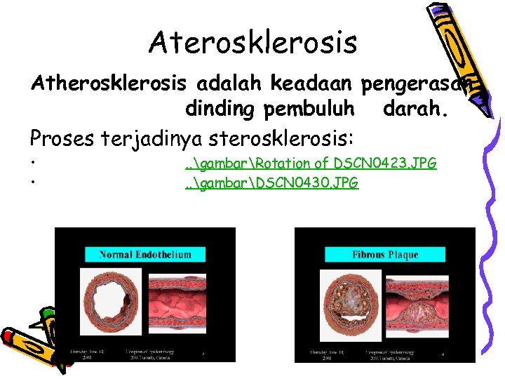 Aterosklerosis Atherosklerosis adalah keadaan pengerasan dinding pembuluh darah. Proses terjadinya sterosklerosis: • • .