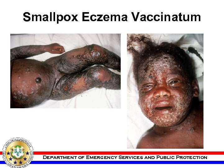 Smallpox Eczema Vaccinatum Department of Emergency Services and Public Protection 