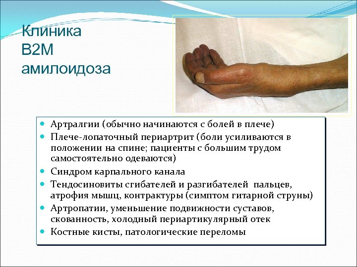 Клиника B 2 M амилоидоза Артралгии (обычно начинаются с болей в плече) Плече-лопаточный периартрит