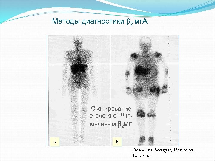 Методы диагностики 2 мг. А Сканирование скелета с 111 Inмеченым b 2 МГ A