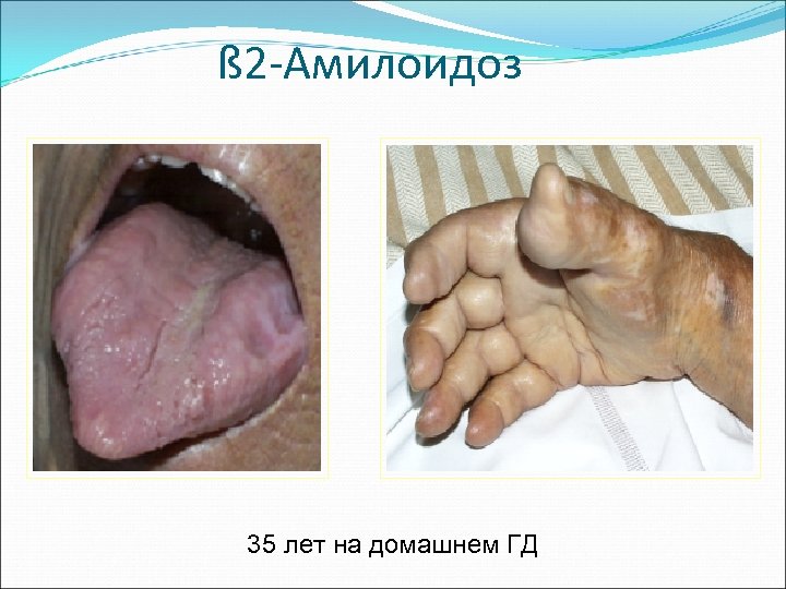 ß 2 -Амилоидоз 35 лет на домашнем ГД 