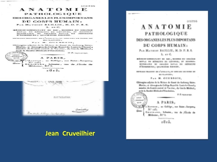 Jean Cruveilhier 