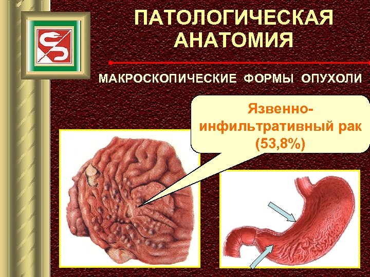 ПАТОЛОГИЧЕСКАЯ АНАТОМИЯ МАКРОСКОПИЧЕСКИЕ ФОРМЫ ОПУХОЛИ Язвенноинфильтративный рак (53, 8%) 